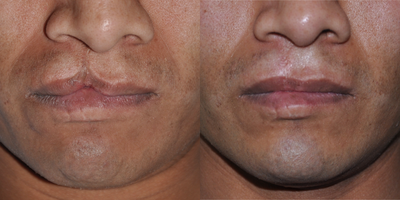 25-34 year old man treated with Cleft Lip Repair - Adult male who underwent a primary incomplete cleft lip repair.