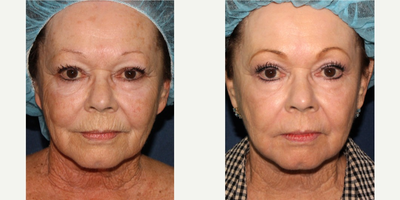 55-64 year old woman treated with Fraxel Repair - Age spots and wrinkles are treated with Fraxel Repair laser