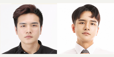 25-34 year old man treated with V Line Surgery, Cheekbone Reduction - Revision Eyelid Surgery, Rhinoplasty, Facial contouring surgery(Jaw reduction, Zygoma Reduction)performed by Seung Ryong Lee MD.