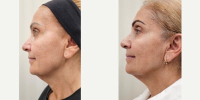 55-64 year old woman treated with Sylfirm X, Alastin Skincare, Ultherapy - Tailored Treatment Plan to treat skin sagging, specially on her neck, acne scars. Patient received Ultherapy session on jowls and upper neck. After 2 months, 2 sessions of our SylfirmX protocol on face and neck, combined with Benev Exosomes and Alastin Skincare. One month between the 1st and 2nd session. Pictures were taken just before her 3rd session.