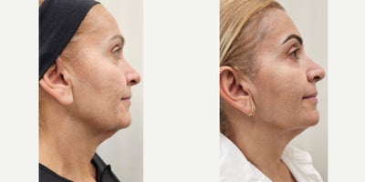 55-64 year old woman treated with Sylfirm X, Alastin Skincare, Ultherapy - Tailored Treatment Plan to treat skin sagging, specially on her neck, acne scars. Patient received Ultherapy session on jowls and upper neck. After 2 months, 2 sessions of our SylfirmX protocol on face and neck, combined with Benev Exosomes and Alastin Skincare. One month between the 1st and 2nd session. Pictures were taken just before her 3rd session.