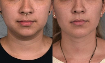 Woman treated with Buccal Fat Removal - V-Line Facial Contouring is performed to improve the profile, jawline, and front view of patients with rounded facial features who want a more sleek appearance. By combining a series of simple procedures such as in this case:Neck LiposuctionMicrocannula Liposuction of the CheeksInsertion of a Chin Implant, andBuccal Fat Removal