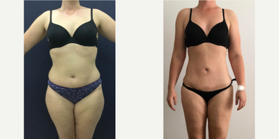 25-34 year old woman treated with Liposuction - Great change for this 28 year old patient from England four months after 360 liposuction and Brazilian butt lift with Premium Care. Surgical time was minimized using two plastic surgeons, and she spent 8 days recovering in Cartagena at our five star Recovery Suites. Her new figure looks great!