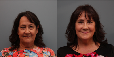 61 year old woman treated with Blue Peel - A Blue Peel was performed at the same time as her facelift and upper and lower eyelids to improve her skin texture and tone. Her result is very dramatic.