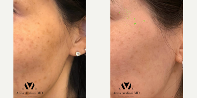 Woman treated with Pico Genesis, Skin Rejuvenation - Woman treated with Pico Genesis, Skin Rejuvenation