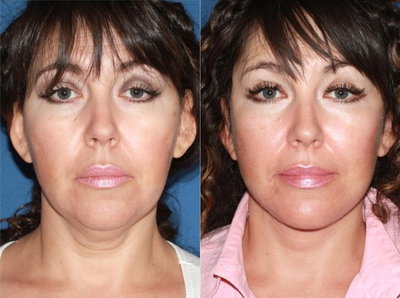 45-54 year old woman treated with Neck Lift - This patient presents with concerns of sagging neck skin and jowls. Good skin quality full cheeks make her an excelent candidate for facial rejuvenation. Face and neck lift was performed to restore the contour of the neck and jawline resulting in a significantly rejuvenated appearance.