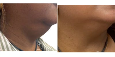 45-54 year old woman treated with Skin Tightening, Endolift - 45 year old desiring laser lipolysis and skin tightening for removal double chin and defining jaw line