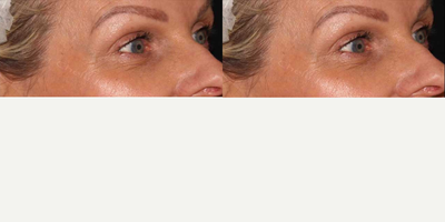 45-54 year old woman treated with CO2 Laser - Patient treated with CO2RE light