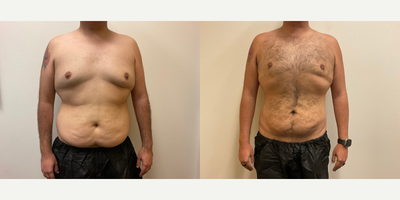 Man treated with Gynecomastia Surgery - Man treated with Gynecomastia Surgery