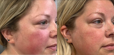 Woman treated with Laser Treatment - Woman treated with Laser Treatment