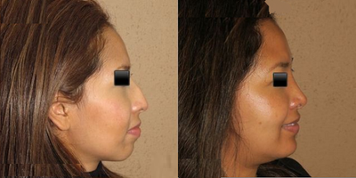 Woman treated with Chin Surgery - Woman treated with Chin Surgery