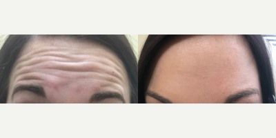 25-34 year old woman treated with Xeomin - Xeomin in forehead by Nurse Injector, Amanda