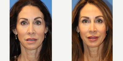 45-54 year old woman treated with Sculptra - This patient was injected with 3 treatments of Sculptra by Dr. Lipschitz. Patient is seen before and after.