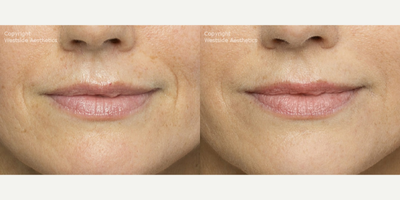 Belotero for Lines Around Mouth - This 42-year-old female patient was concerned with the fine lines around her mouth. Dr. Rivkin injected Belotero, a dermal filler, to correct the etched-in lines and wrinkles around her mouth.