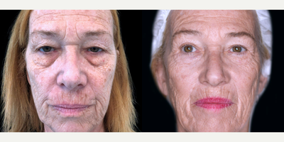 65-74 year old male treated with TotalFX - DeepFX to peri-oral + peri-orbital, ActiveFX to full face