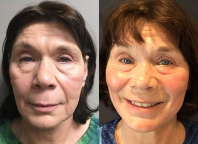 55-64 year old woman treated with Eyelid Surgery - Patient had a Lower Lid Bleph with resurfacing performed