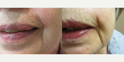 75 and up year old woman treated with GentleLase - Removal of Venous Lake on Left Lower Lip with one GentleLase Treatment