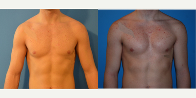 18-24 year old man treated with Pec Implants - pectoral implants