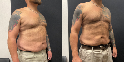45-54 Man: 45-Pound Ozempic Oblique-View Result Ozempic before and after men transformation