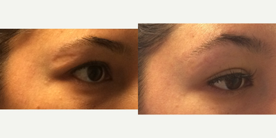 29 year old woman treated with Bellafill - 29 year old female with a old traumatic scar along the brow. She was treated with Bellafill to fill in the atrophic scar. She required 2 sessions 4 weeks apart. Note how the scar has filled in with a smoother contour and is less noticeable.
