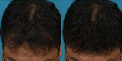 45-54 year old man treated with PRP for Hair Loss - 45 year old man concerned about hair thinning and hair loss. The doctorrecommended PRP hair restoration treatments. Pt is currently on topicals to stop the hair loss. This is the result after 6 PRP treatments.