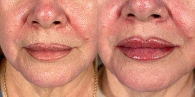 64 year old woman treated with Restylane Defyne - This 64-year-old patient received a lip enhancement using one syringe of Defyne filler, administered by Dr. Jochen. In the before photos, her lips appear thinner, with less definition in the borders. The after photos, taken immediately post-treatment, show a fuller, more defined shape with enhanced volume and a smooth, natural contour. The Defyne filler adds a subtle plumpness that complements her natural features, providing a refreshed and youthful look without looking overdone.