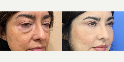 Woman treated with Eyelid Surgery - Woman treated with Eyelid Surgery