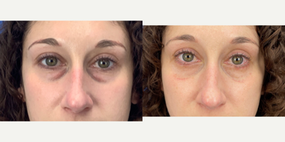 35-44 year old woman treated with Eyelid Surgery - Lower Blepharoplasty