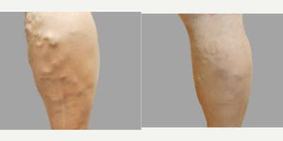 45-54 year old man treated with VenaSeal - Treatment for chronic venous insufficiency