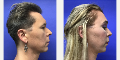 Patient treated with Facial Feminization Surgery, Transgender Facial Feminization Surgery, Septoplasty, Rhinoplasty, Voluma, Juv - 35 to 44 year-old female patient is 3 months post-op from Facial Feminization surgery. Her procedures included: Forehead Lift, Hairline Lowering, Supra Orbital Bone Reduction and Contouring, Septorhinoplasty (closed) with Cartilage Grafts and Radix Graft, Chin Reduction and Contour, Lower Eyelid Blepharoplasty (TC) with Fat Reposition, Thyroid Cartilage Shave and Voice Feminization, Fascia to Lips, 500 Micrografts to Recessions, 35% TCA Peel - Periorbital, 2cc Voluma to Medial Cheeks, and 2cc Juvederm - Perioral.