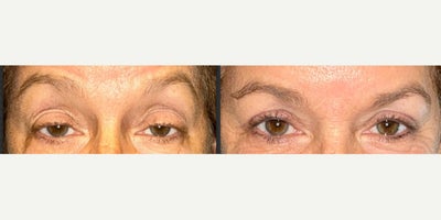 55-64 year old woman treated with Ptosis Surgery - -60 yo woman before and 2 months after bilateral upper lid ptosis repair