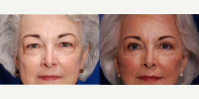 65-74 year old woman treated with Eyelid Surgery - upper and lower blepharoplasty performed by Facial Plastic Surgeon - Sean R. Weiss, MD