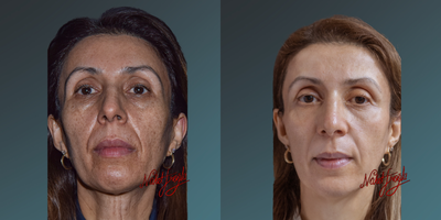 35-44 year old woman treated with PicoSure - PicoSure is a laser technology used to treat skin pigmentation issues, tattoos, scars, and blemishes. It operates using ultra-short (picosecond) laser pulses, breaking down pigmentation for the body to naturally clear. It's known for potentially delivering effective results in fewer sessions compared to other laser systems. PicoSure may reduce the appearance of spots, tattoos, or marks while promoting younger-looking, smoother skin by stimulating collagen production. Treatment duration varies based on individual skin conditions and goals. Consulting a dermatologist or specialist before using this technology is crucial.