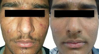 Venus Viva - Before and After 5 Treatments. &nbsp;Photos provided courtesy of Venus Concept, performed by Megha Joy Shah, MD.