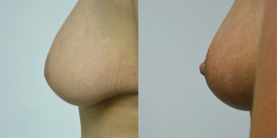 25-34 year old woman treated with Nipple Surgery for retracted/inverted nipple correction - A mother of one in her later 20s who is bothered by inverted (retracted) nipples. Her right side was moderate and her left side severe according to the classification of Han and Hong. According to Han and Hong, mild or grade I retraction is where the nipple can be pulled out easily and maintains its projection without traction. Moderate or grade II is when the nipple can also be pulled out manually, although not as easily as with grade I and has difficulty maintaining its position with a tendency to retract. Severe inversion, or grade III the nipple is difficult to pull out manually. Nipple retraction is caused by short and retracted milk ducts. To correct this, these ducts are divided under local anesthesia with a special blade through a micro incision and held out to length temporarily with a traction suture while healing is taking place. She had initial correction with the micro-incision technique under local anesthesia in the office. Although it is rare, she did not achieve satisfactory correction with the first procedure and continued to have some retraction. We returned when she was available for surgery 10 months later and she had a second micro-incision technique on each side. She is shown now at 6 weeks after this second procedure, and has maintained a normal nipple projection. She is happy to feel normal again and confident about the appearance of her breasts after correcton.