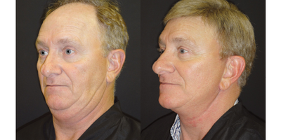 45-54 year old man treated with Quick Lift - 45-54 year old man