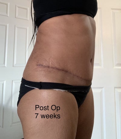 Swelling/puffiness in mons pubis - Hot Topics, Forums