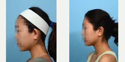 18-24 year old woman treated with Earfold - Six weeks post - otoplasty with Dr. Wise in New Jersey, this 18-year-old patient is very happy her ears no longer stick out. She also noted that the recovery was much easier than she had anticipated.
