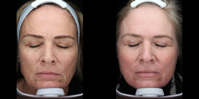 55-64 year old woman treated with ProFractional Laser - Patient did Profractional full face treatment and was given post care skin care products