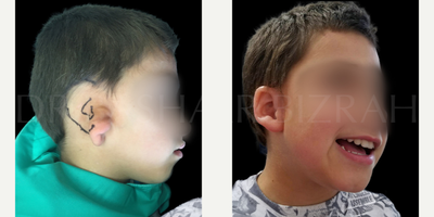 17 or under year old kid treated with Ear Surgery, Earfold, Earlobe Repair - Microtia Ear Reconstruction