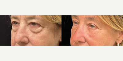 67 year old woman treated with Eyelid Surgery, Facial Fat Transfer - 67 year old woman treated with Eyelid Surgery, Facial Fat Transfer