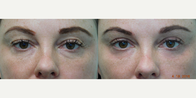 40 year old woman treated with Upper Eyelid Surgery and Lower Eyelid Fractional CO2 Laser - This mother of three consulted with us for rejuvenation of her eyes. She stated that her eyelids looked heavy and the skin underneath her eyes seemed overly wrinkled. We decided together to perform an upper eyelid lift (blepharoplasty) along with a fractional CO2 laser treatment of her lower eyelids. Her results demonstrate a natural, well rested appearance (with some very mild temporary pinkness still under her lids (no makeup for these photos) which may persist for an additional week or so).