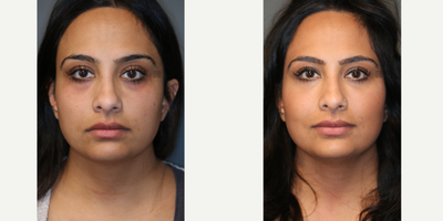 Microstructural Tear Trough FIller - Cannula used to add microstructural volume to improve bags and dark circles.