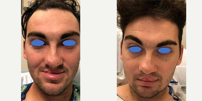 Man treated with Cleft Lip And Palate Repair - Man treated with Cleft Lip And Palate Repair.
