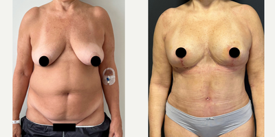 55-64 year old woman treated with Tummy Tuck, Breast Lift, Vaser Liposuction - 63 Y, Female, Tummy Tuck & Breast Lift & 360 Vaser Liposuction was performed.