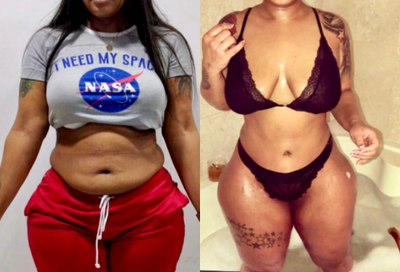 Results after Full Tummy Tuck, Intense Liposuction and Dominican Butt Lift - Excellent outcome after full tummy tuck combined with intense liposuction including abdomen, waist, laterals and upper and lower back to improve your body contour and get better curves, especially in your waist area and dominican butt lift.