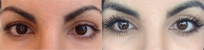 Female Latisse Results - 
	Patient was unhappy with her lashes. These results are after just 2 month of using Latisse daily.
