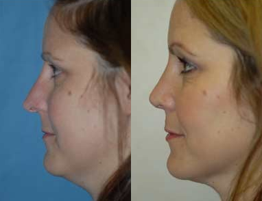 Revision Rhinoplasty - Revision Rhinoplasty