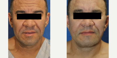 35-44 year old man treated with Brow Lift, Neck Lift, Facelift - This patient in his mid 40s had a brow lift, buccal fat removal, neck lift, and facelift. He disliked his frown lines and wanted a more youthful appearance.