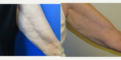69 year old woman treated with Profound RF - This patient did not like the crepey loose skin on her arms. She had a profound RF treatment to tighten this loose skin. After photo taken 6 months later.